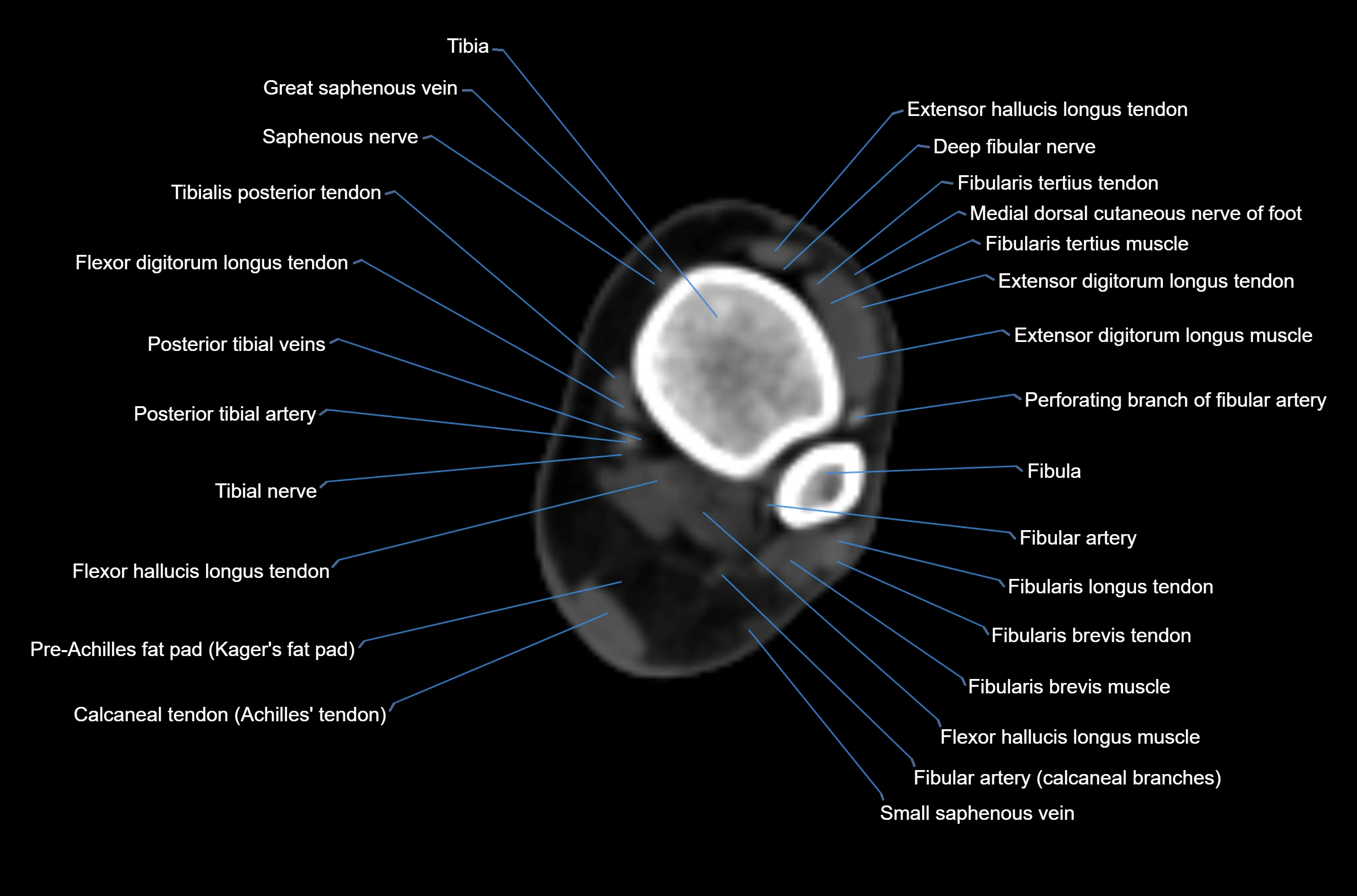 CT Ankle axial cross sectional anatomy labelled image -00022.webp